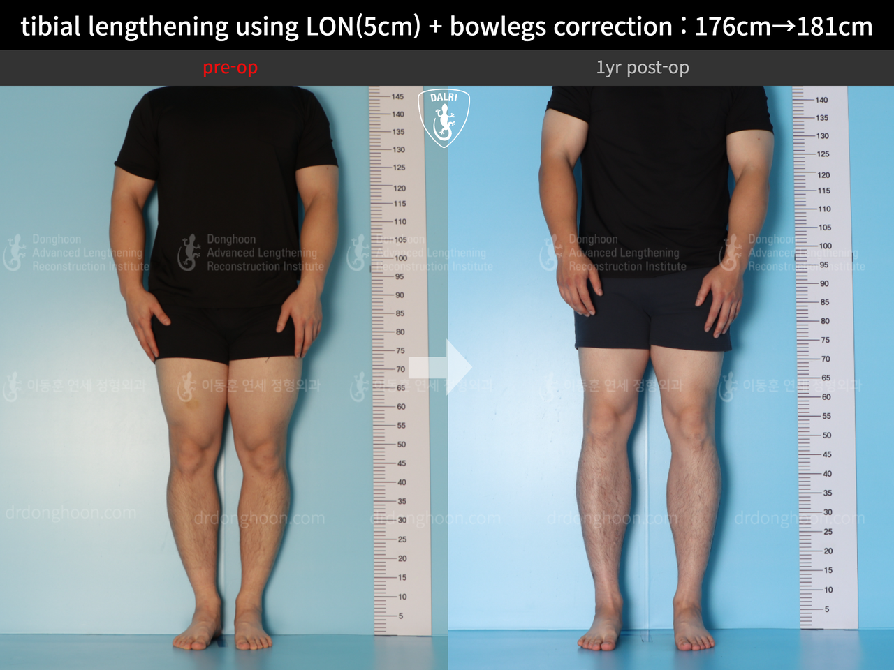 Before and after cll + deformity correction, case 13410849, image 2, Dr. Donghoon institute (DALRI)