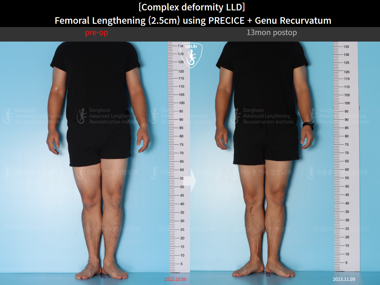 Before and after complex deformity, case 16854696, image 4, Dr. Donghoon institute (DALRI)