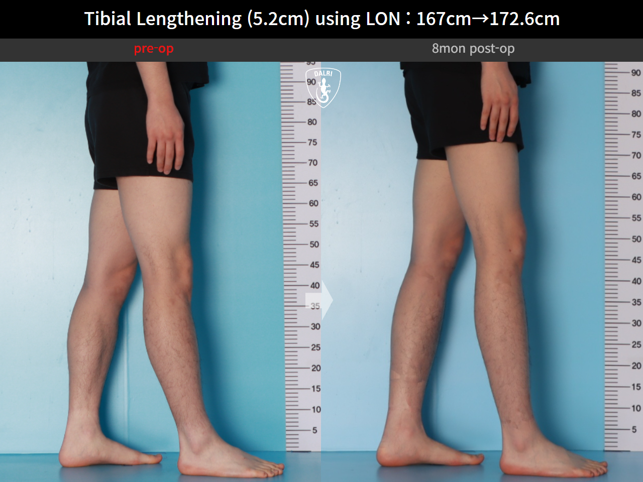 Before and after cll lon, case 29672720, image 10, Dr. Donghoon institute (DALRI)