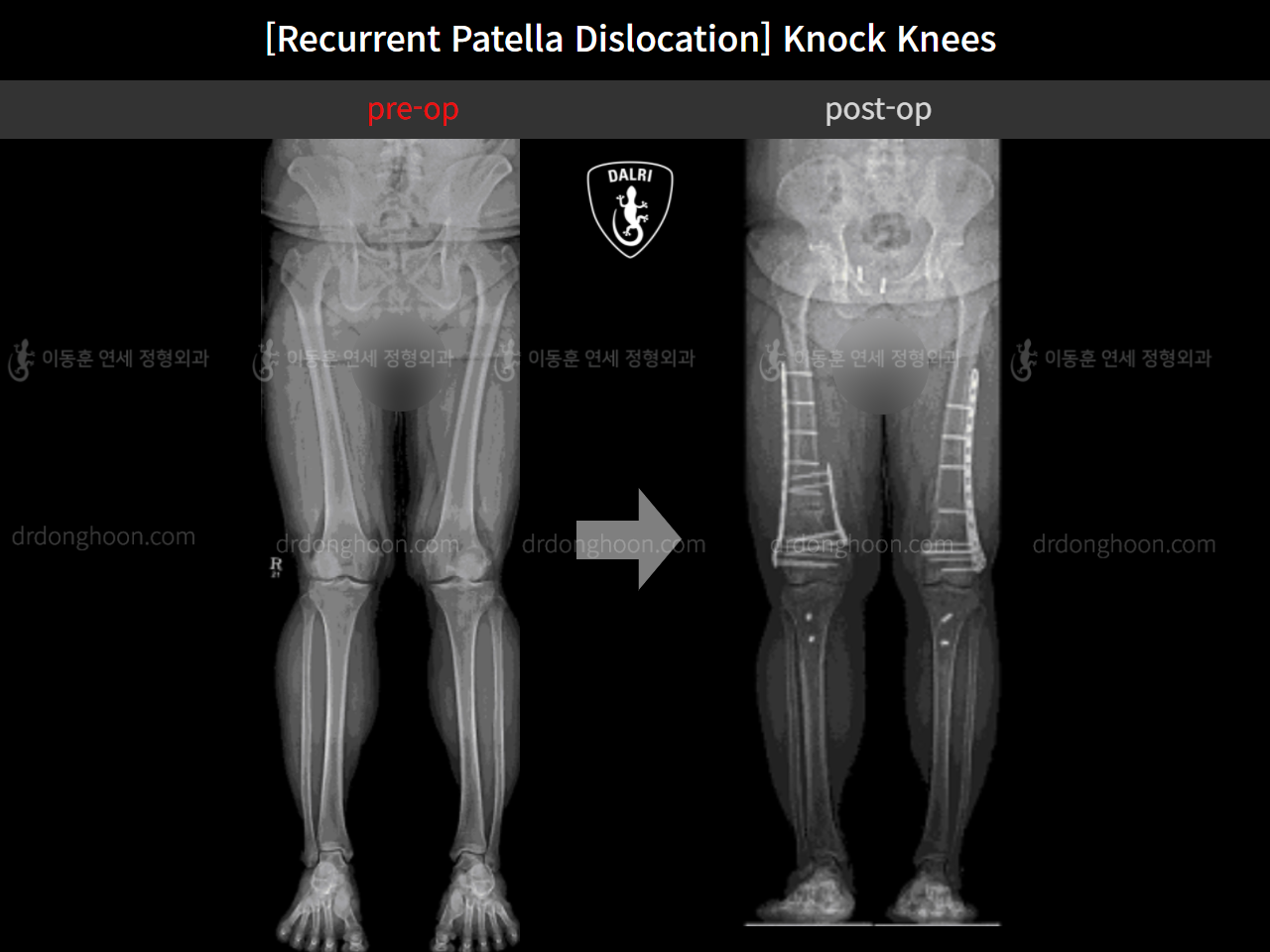 Before and after recurrent patella dislocation, case 10710327, image 7, Dr. Donghoon institute (DALRI)