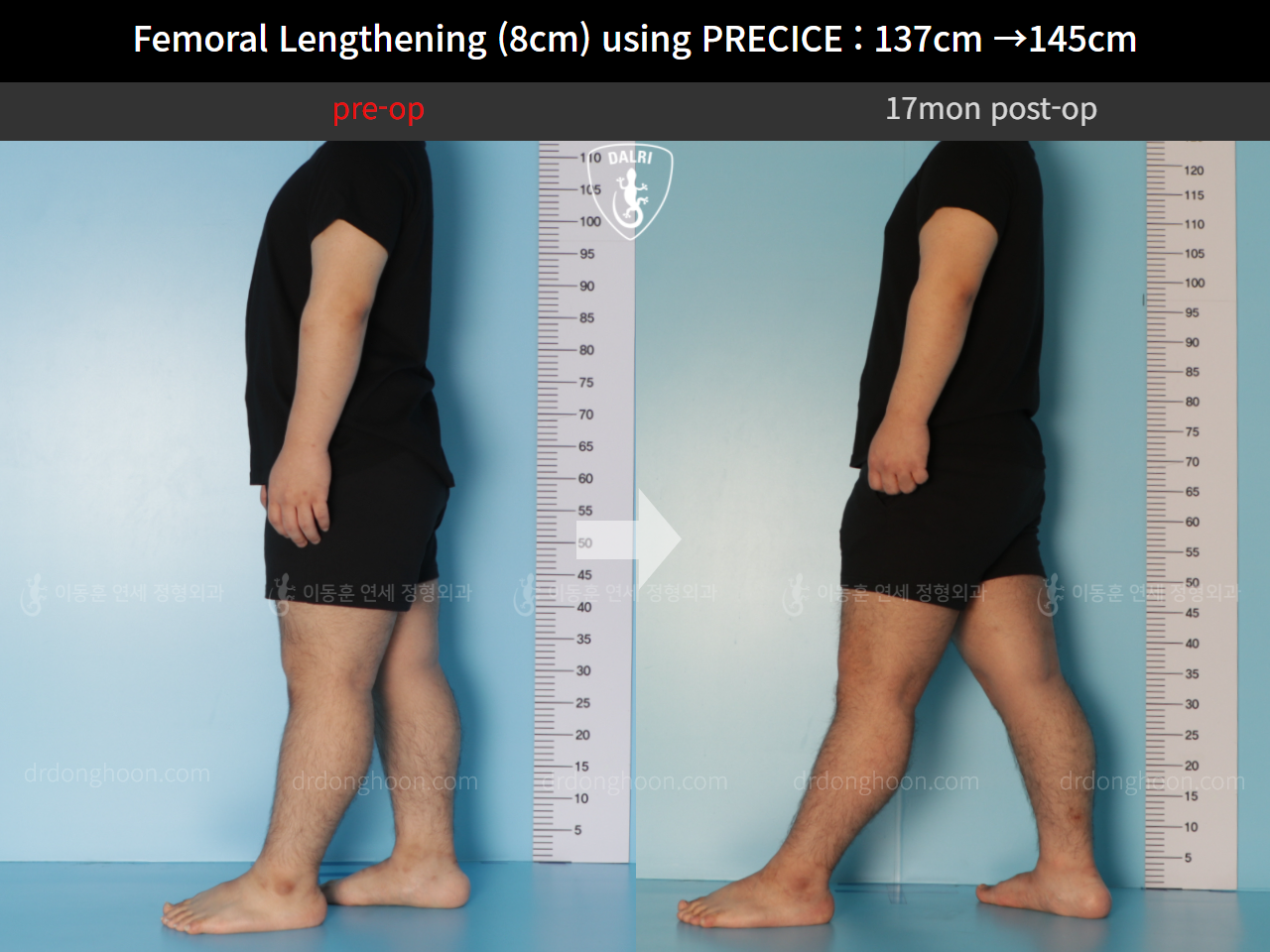 Before and after cll precice, case 9658893, image 4, Dr. Donghoon institute (DALRI)