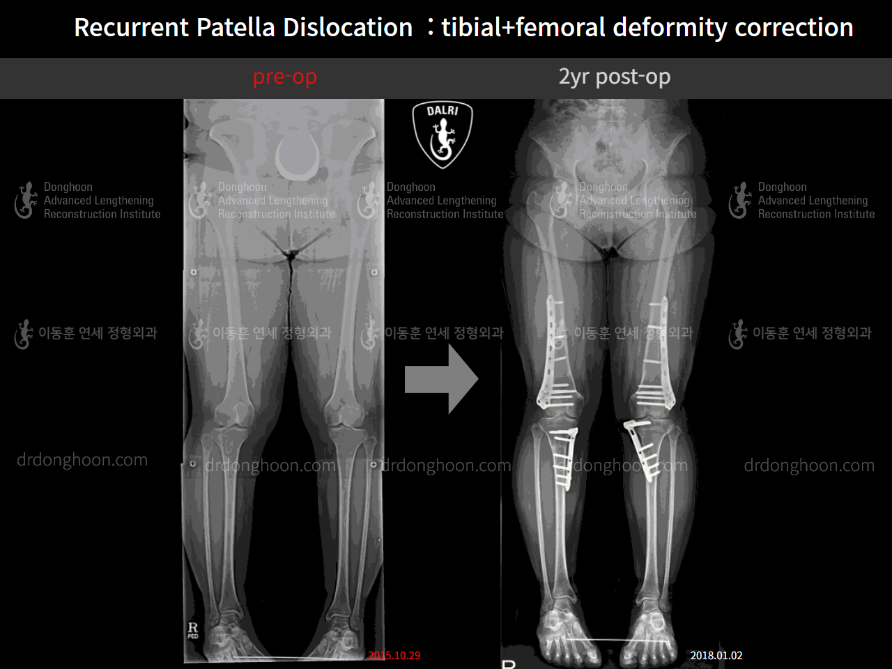 Before and after recurrent patella dislocation, case 9869087, image 1, Dr. Donghoon institute (DALRI)