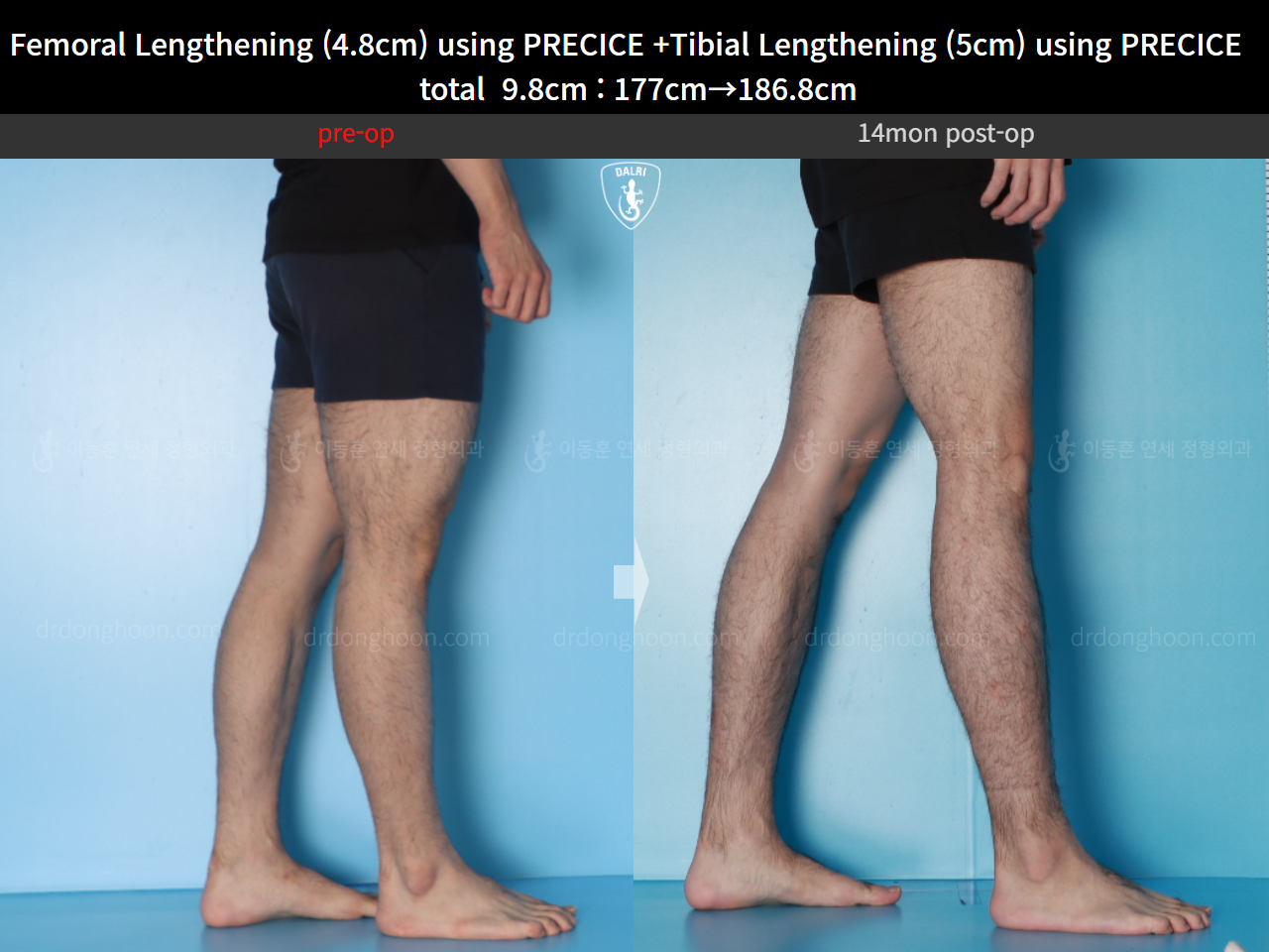 Before and after cll precice, case 16780196, image 9, Dr. Donghoon institute (DALRI)