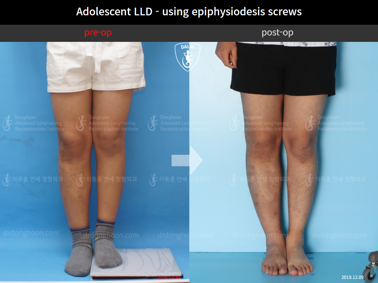 Before and after paediatric & adolescent lld, case 10452092, image 3, Dr. Donghoon institute (DALRI)