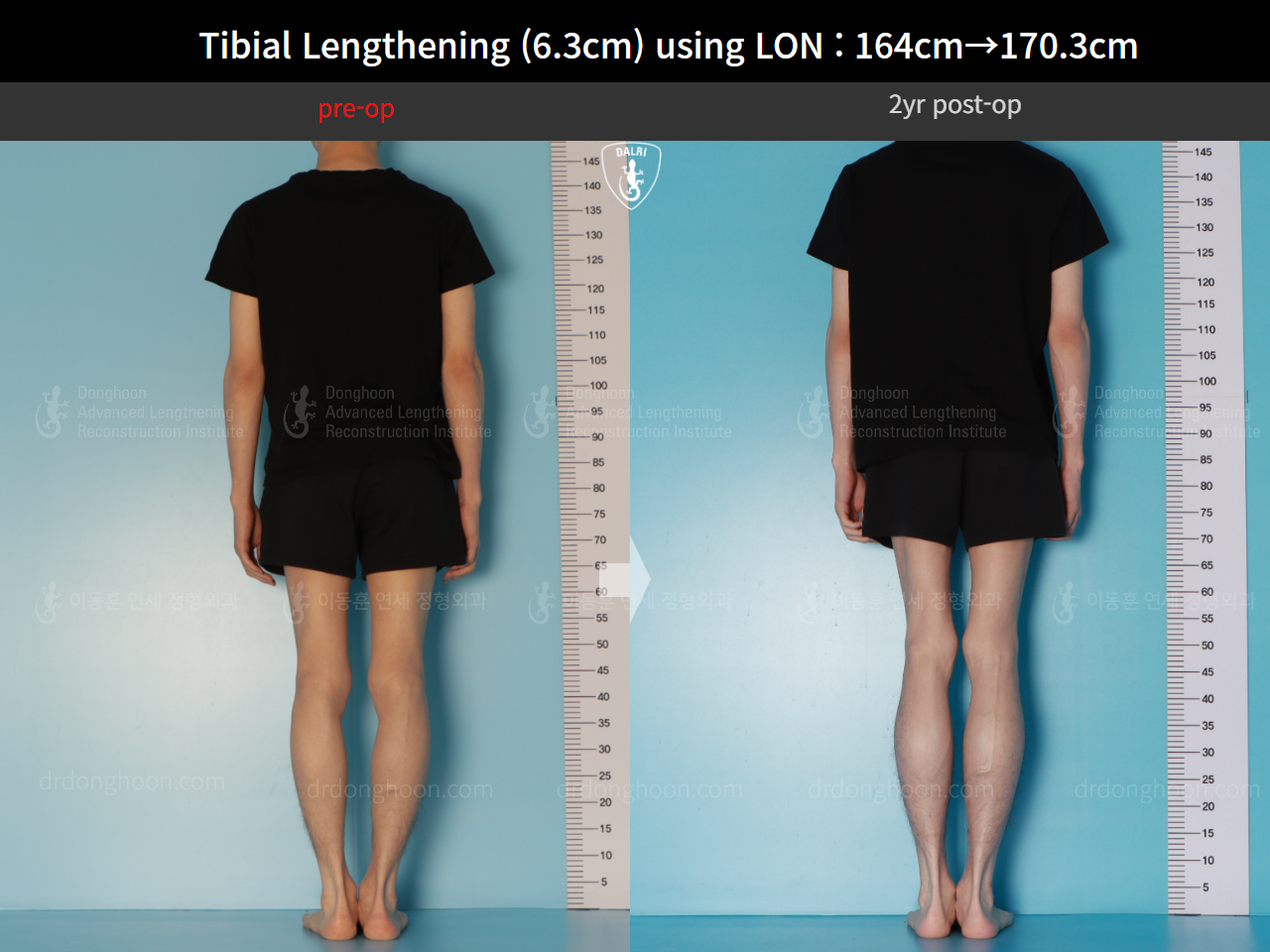 Before and after cll lon, case 16723608, image 3, Dr. Donghoon institute (DALRI)
