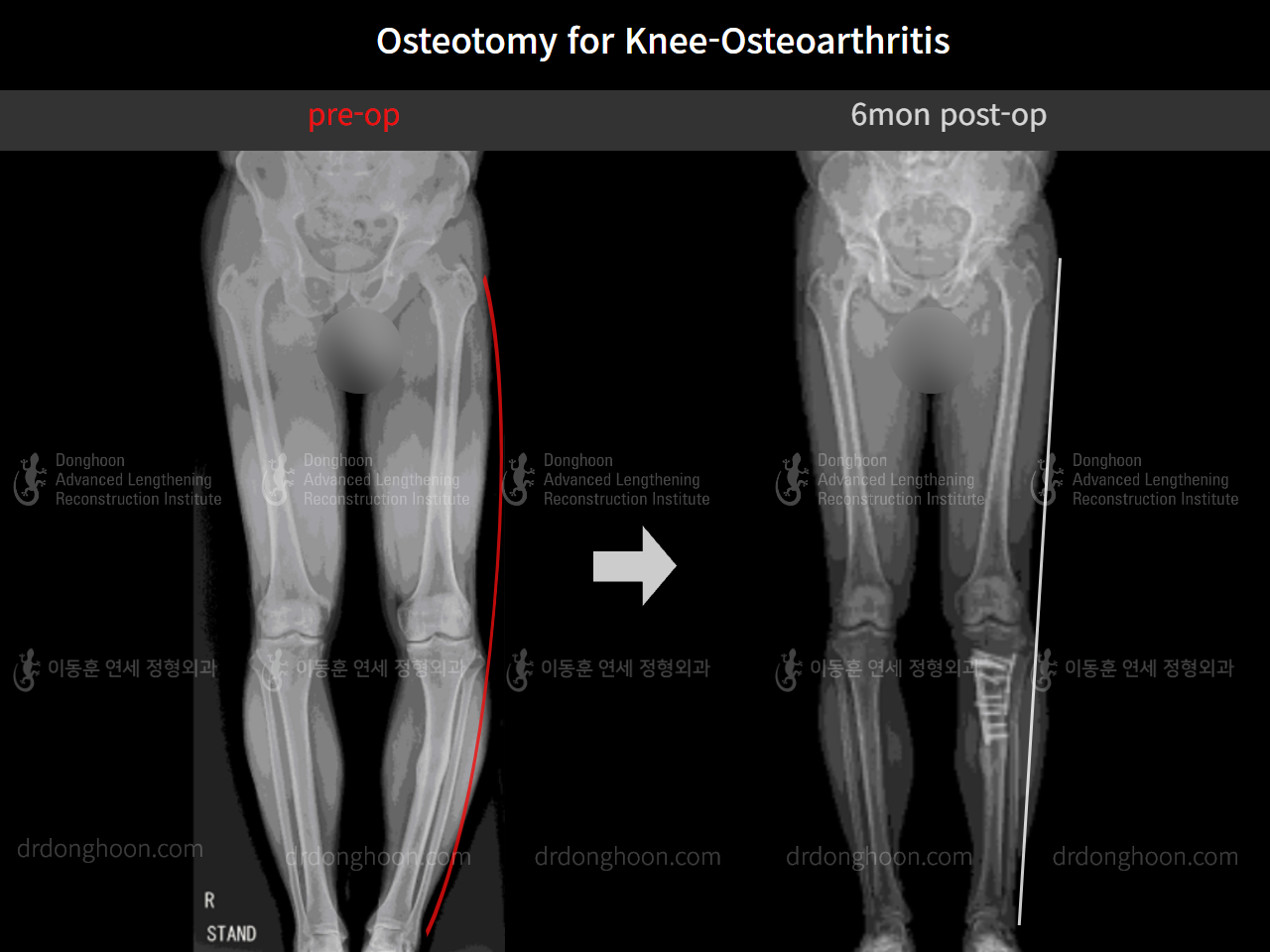 Before and after osteotomy for knee osteoarthritis, case 8796980, image 7, Dr. Donghoon institute (DALRI)