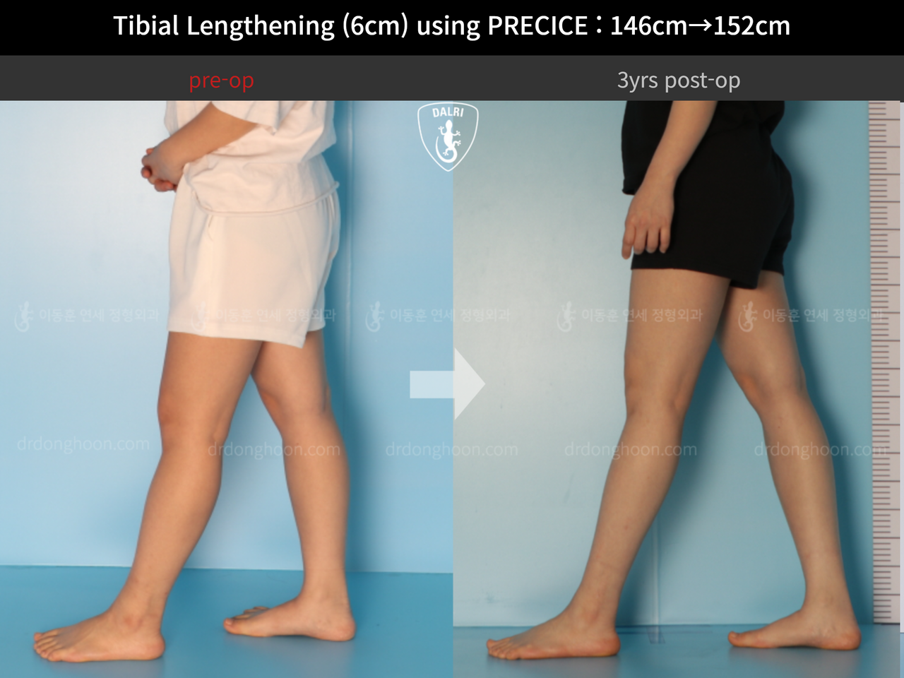 Before and after cll precice, case 4573599, image 7, Dr. Donghoon institute (DALRI)