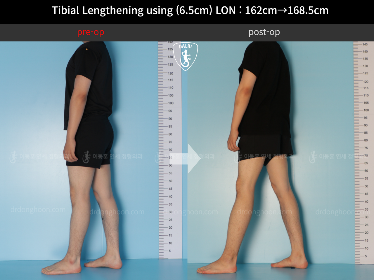 Before and after cll lon, case 11944171, image 4, Dr. Donghoon institute (DALRI)