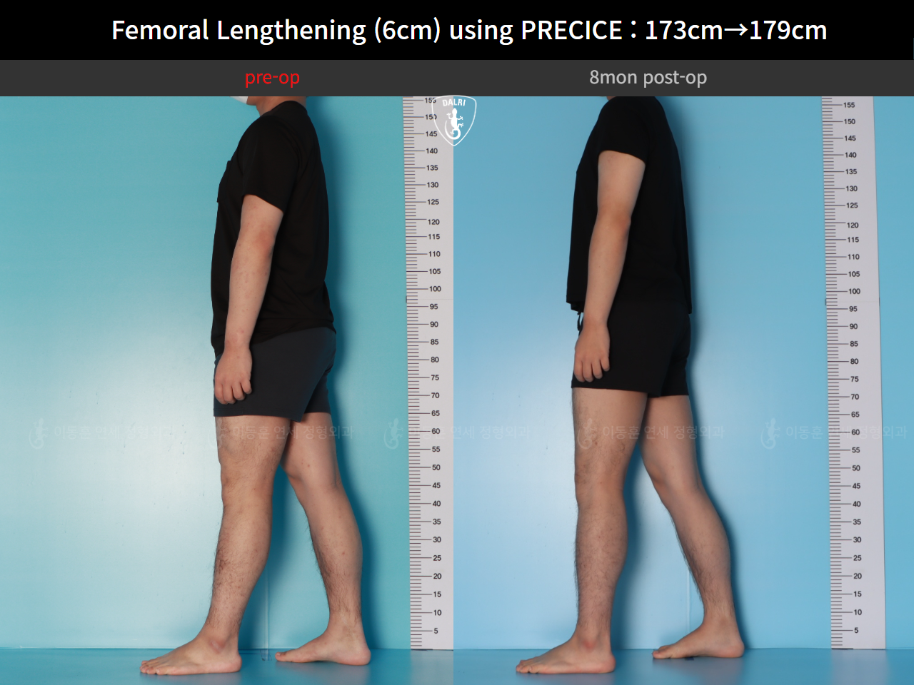 Before and after cll precice, case 89066969, image 5, Dr. Donghoon institute (DALRI)