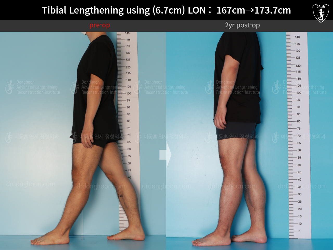 Before and after cll lon, case 16165376, image 3, Dr. Donghoon institute (DALRI)