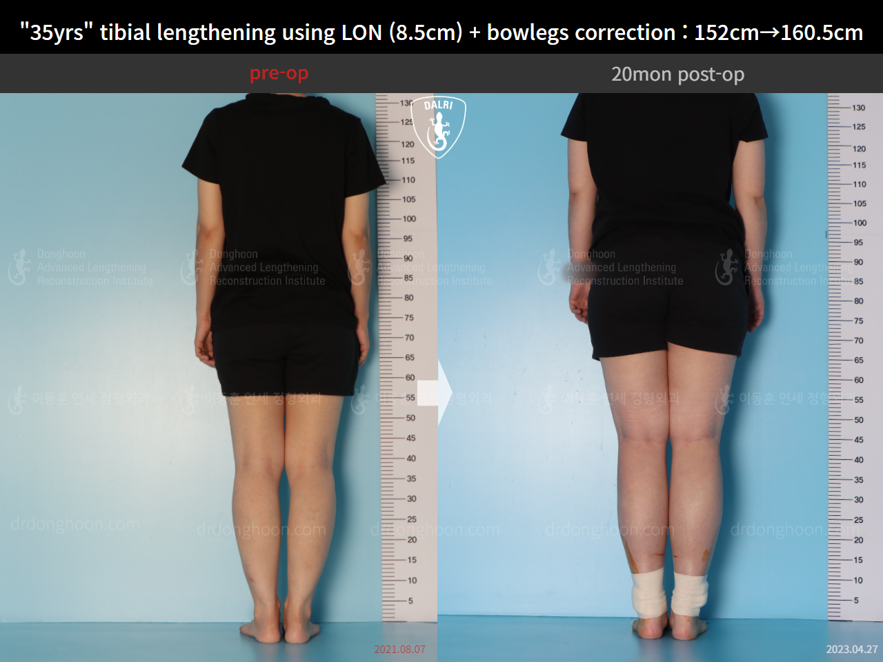 Before and after cll + deformity correction, case 15036694, image 3, Dr. Donghoon institute (DALRI)