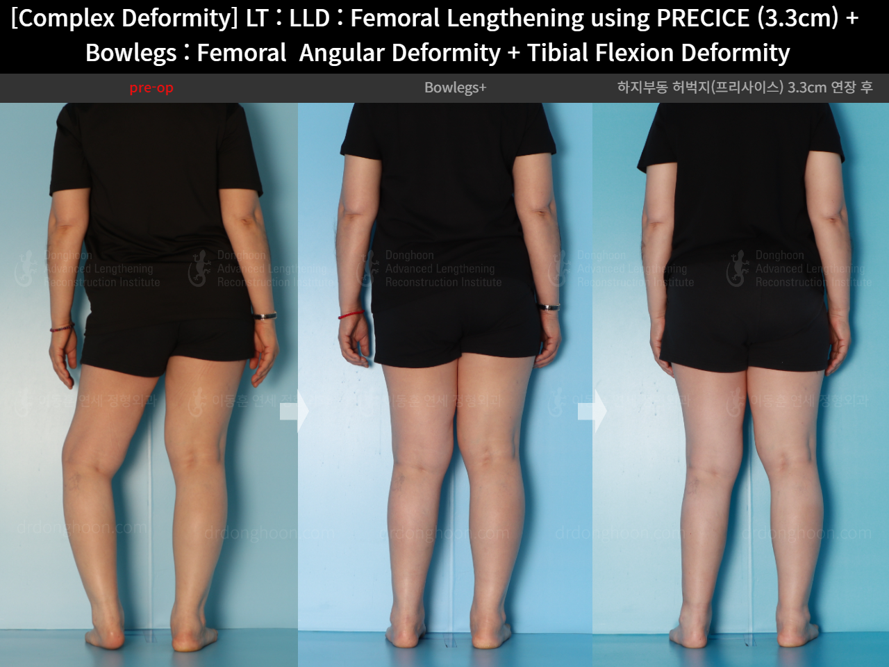 Before and after adult lld, case 16786688, image 4, Dr. Donghoon institute (DALRI)
