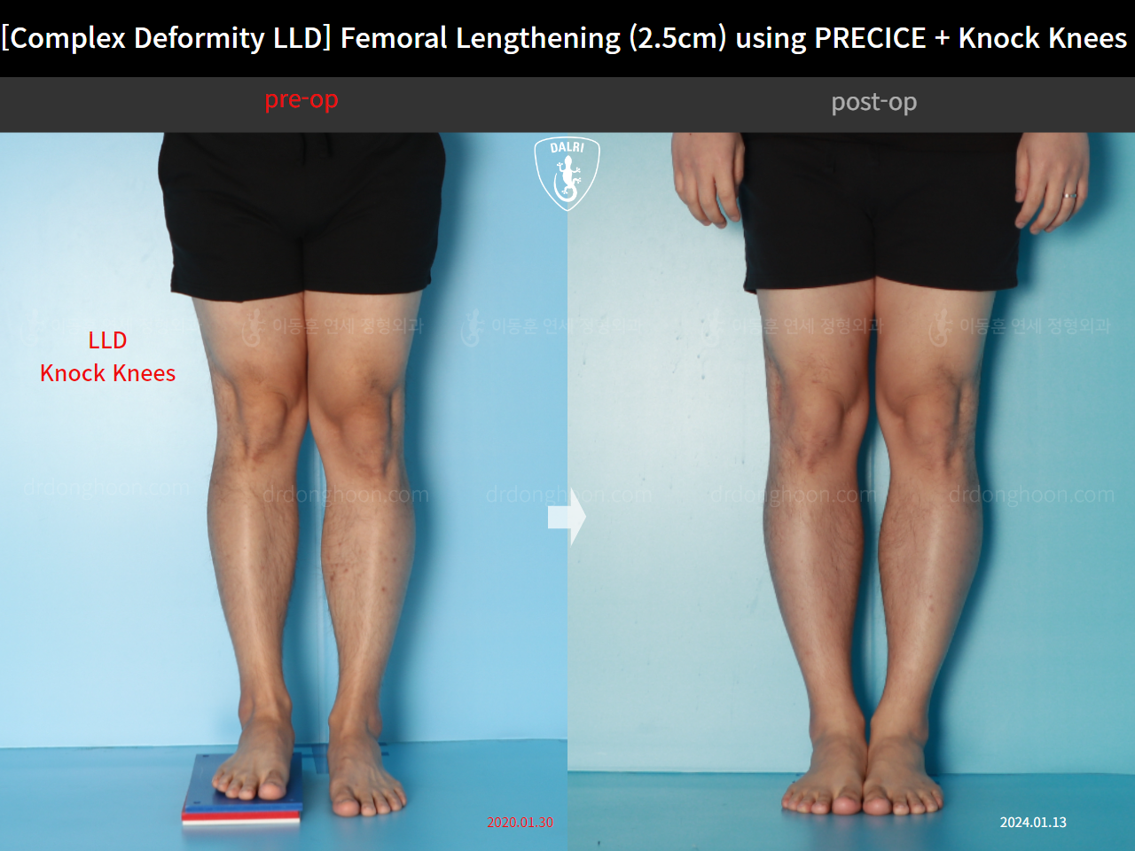 Before and after adult lld, case 17589131, image 5, Dr. Donghoon institute (DALRI)