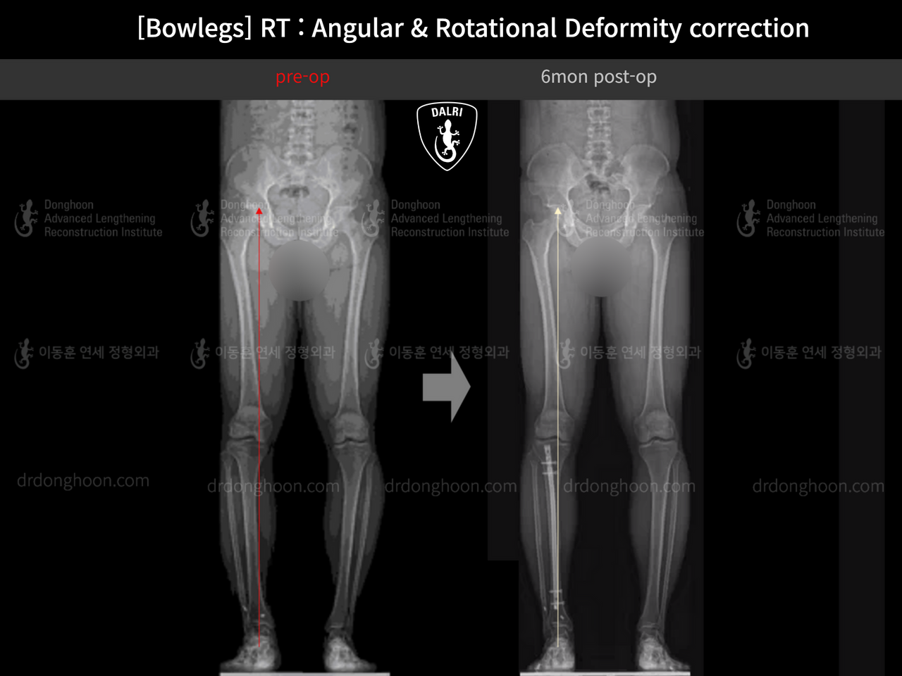Before and after adult bowlegs, case 13664056, image 6, Dr. Donghoon institute (DALRI)