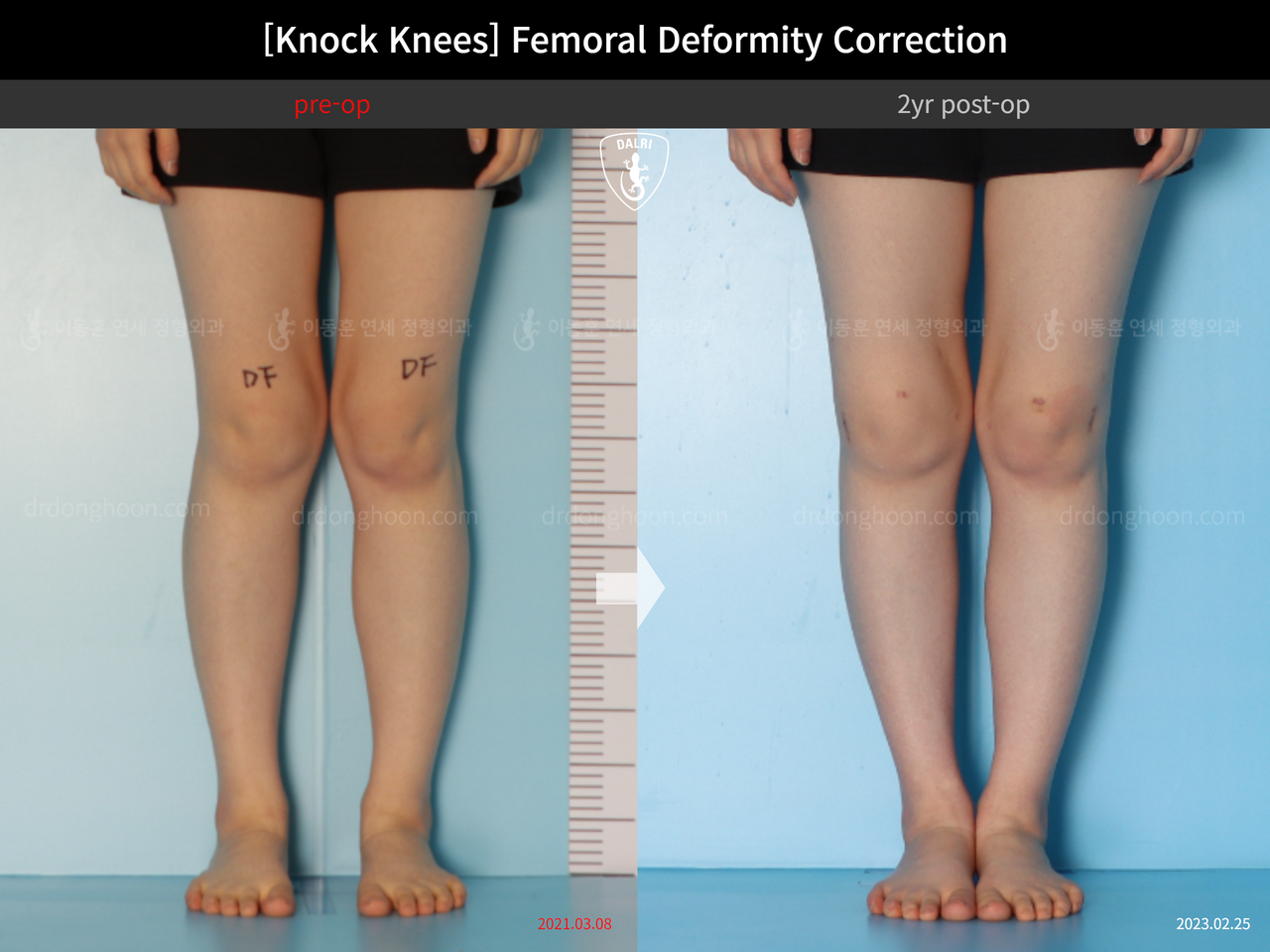 Before and after adult knock knees, case 14343877, image 3, Dr. Donghoon institute (DALRI)