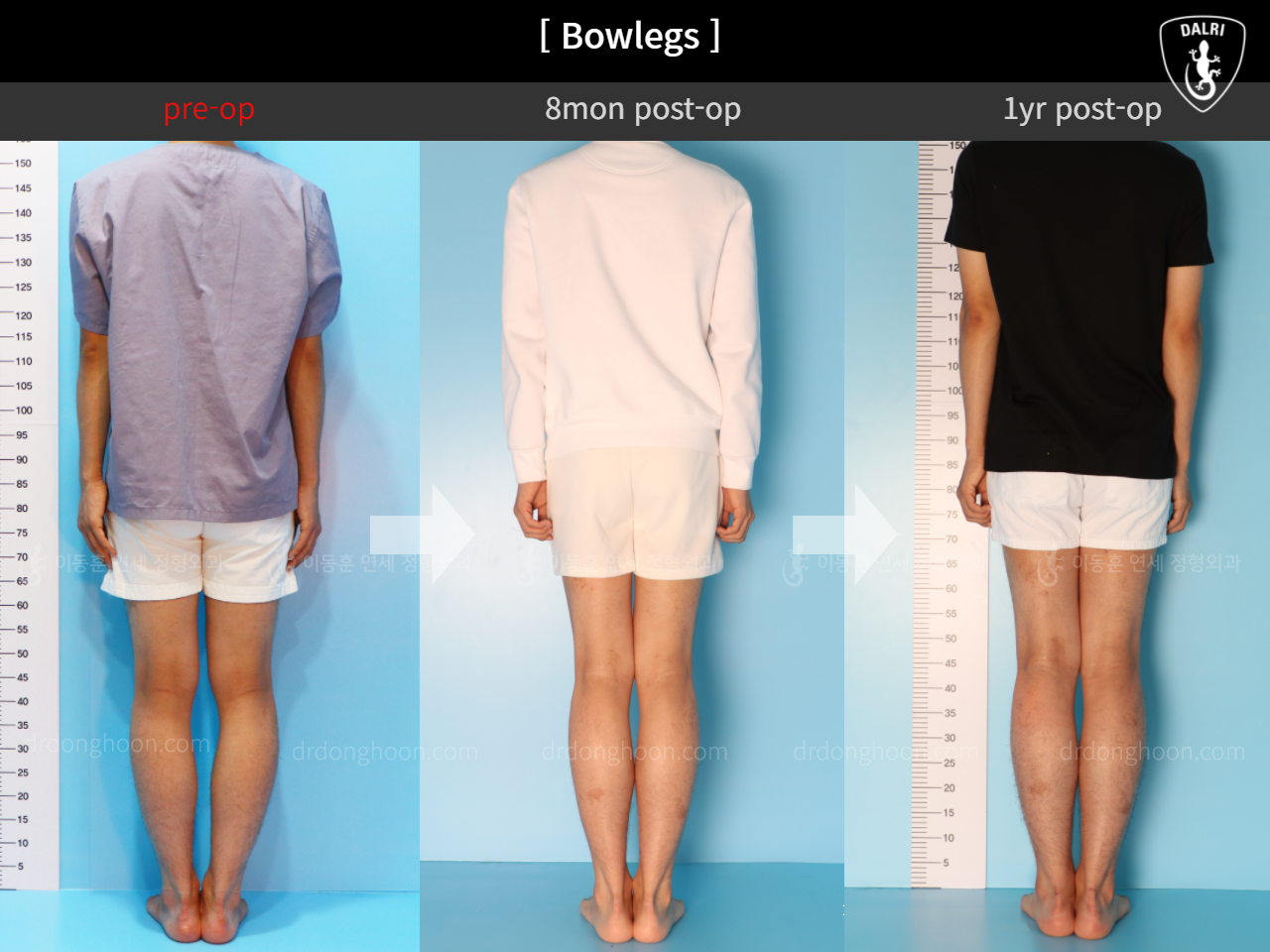 Before and after adult bowlegs, case 4311053, image 2, Dr. Donghoon institute (DALRI)