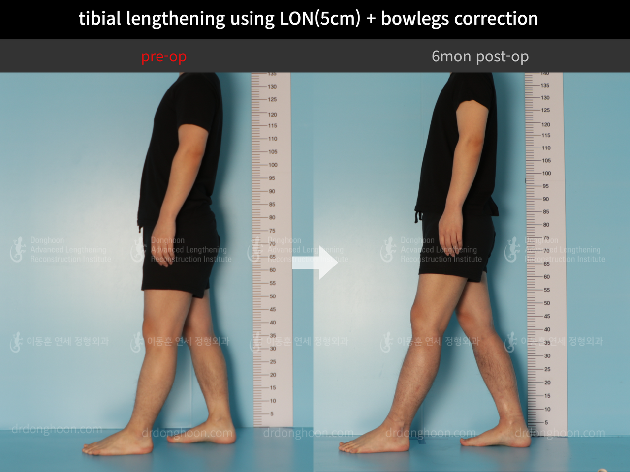Before and after cll + deformity correction, case 11925306, image 4, Dr. Donghoon institute (DALRI)