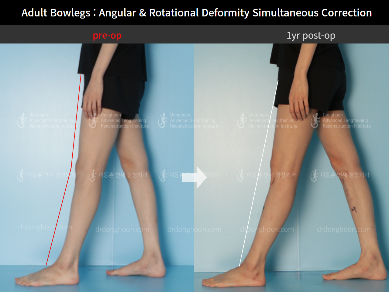 Before and after adult bowlegs, case 9058125, image 5, Dr. Donghoon institute (DALRI)