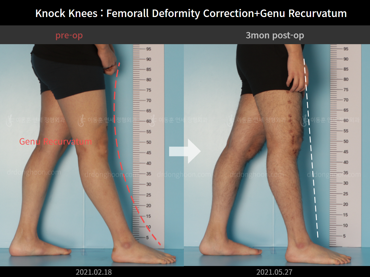 Before and after adult knock knees, case 7165631, image 6, Dr. Donghoon institute (DALRI)