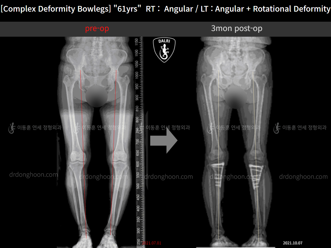 Before and after osteotomy for knee osteoarthritis, case 11576611, image 8, Dr. Donghoon institute (DALRI)