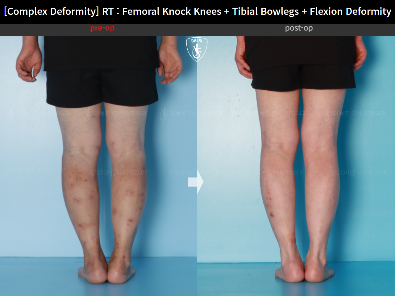 Before and after complex deformity, case 16507040, image 7, Dr. Donghoon institute (DALRI)
