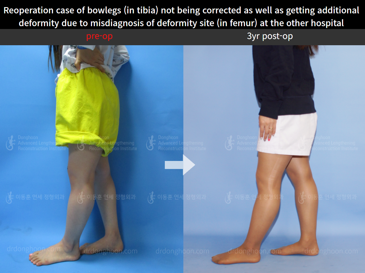 Before and after reoperation after deformity correction, case 5306623, image 4, Dr. Donghoon institute (DALRI)