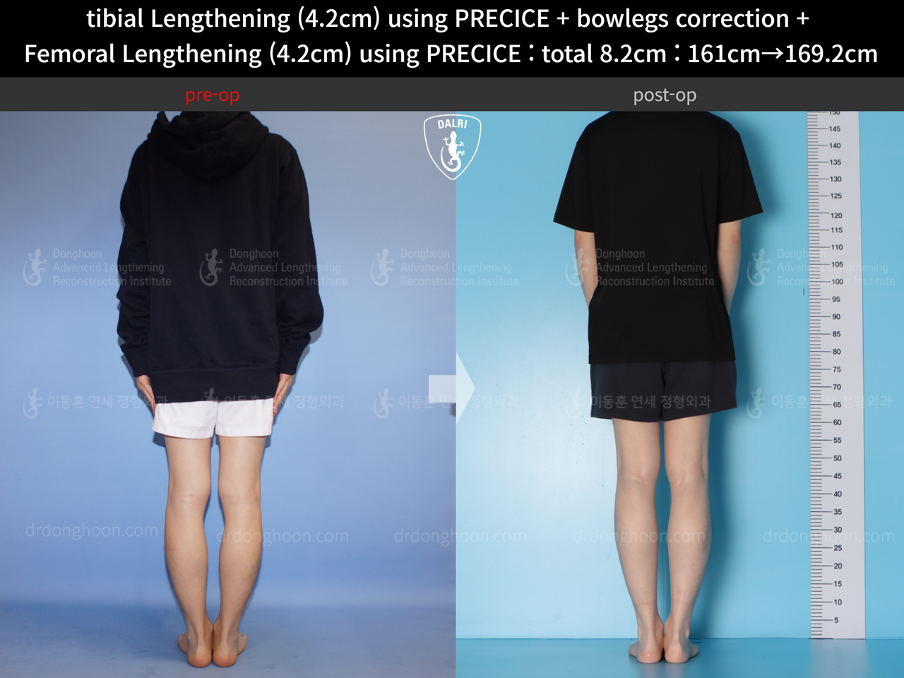 Before and after cll precice, case 14235714, image 2, Dr. Donghoon institute (DALRI)