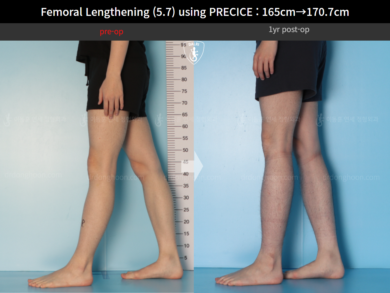 Before and after cll precice, case 15417090, image 10, Dr. Donghoon institute (DALRI)