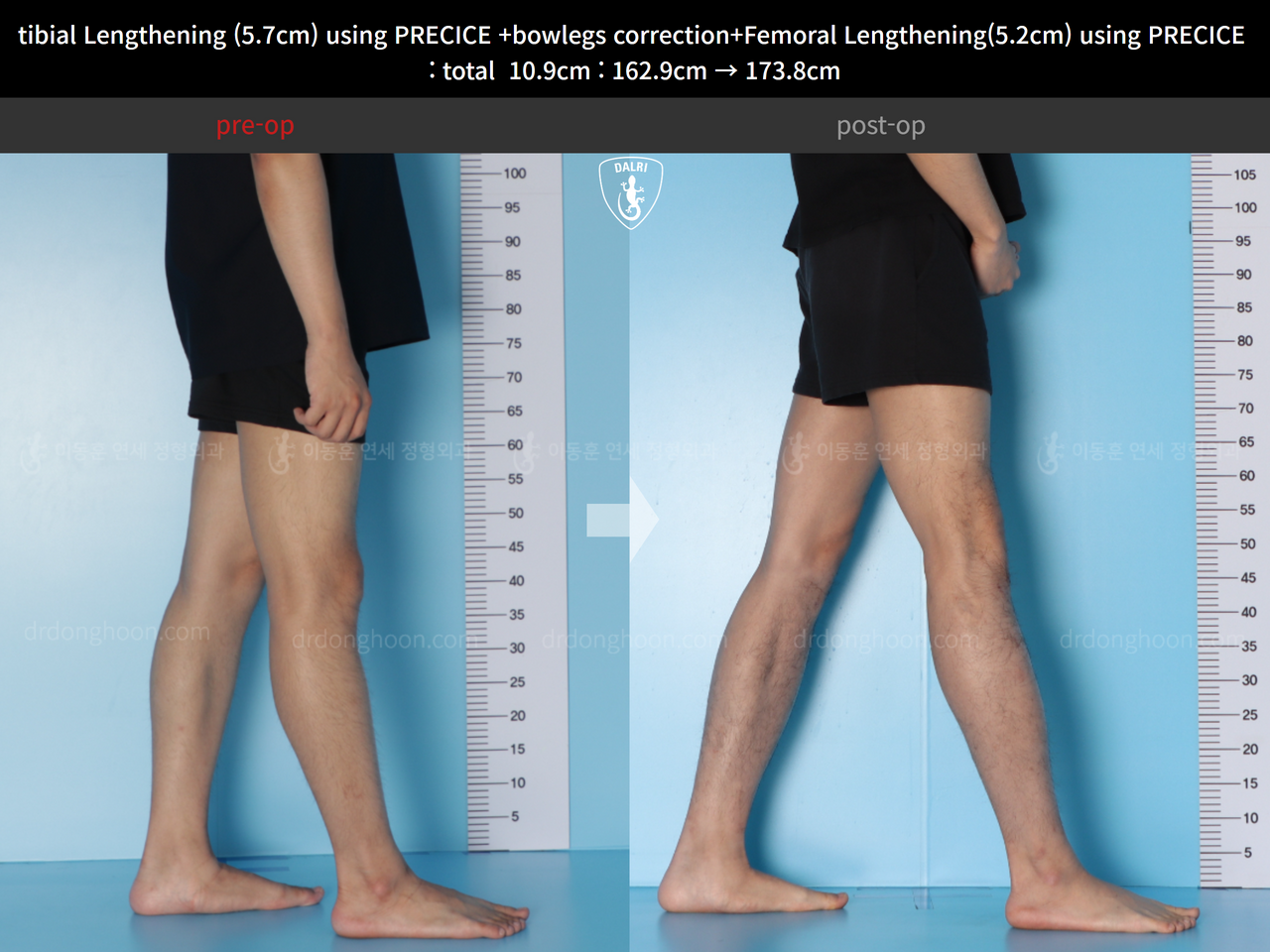 Before and after cll + deformity correction, case 13924912, image 7, Dr. Donghoon institute (DALRI)
