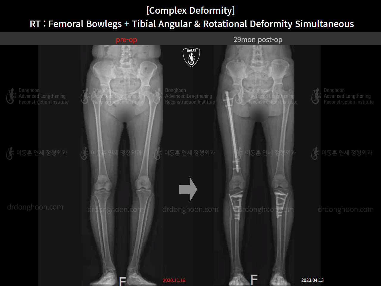 Before and after adult bowlegs, case 14771490, image 14, Dr. Donghoon institute (DALRI)