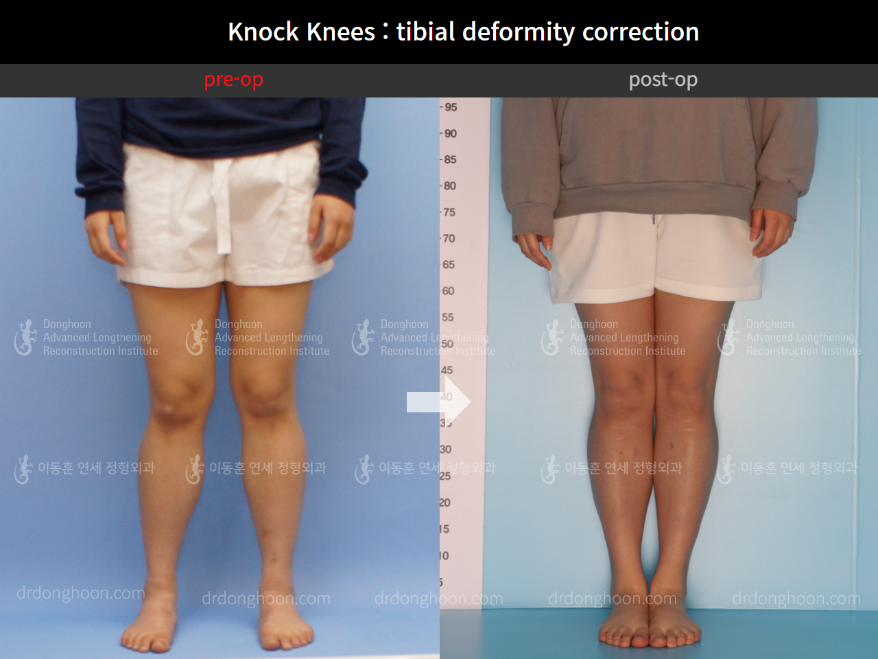 Before and after adult knock knees, case 4586314, image 3, Dr. Donghoon institute (DALRI)