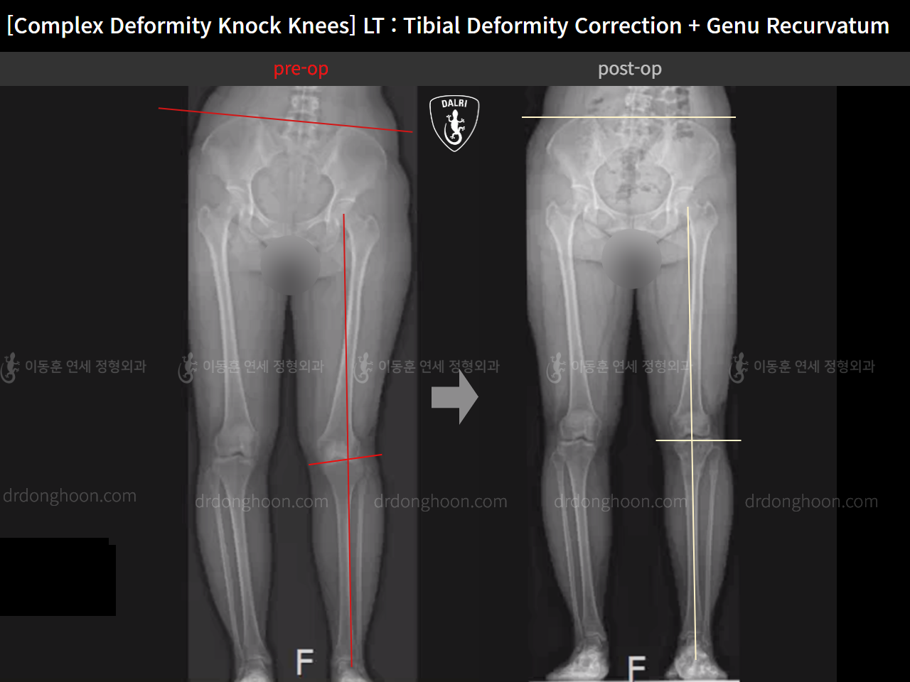 Before and after genu recurvatum, case 15801545, image 3, Dr. Donghoon institute (DALRI)