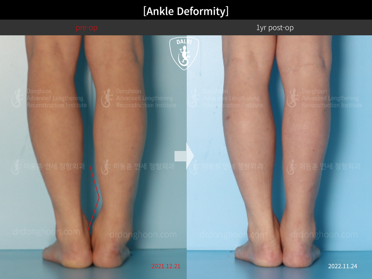 Before and after foot & ankle deformity, case 13580612, image 2, Dr. Donghoon institute (DALRI)