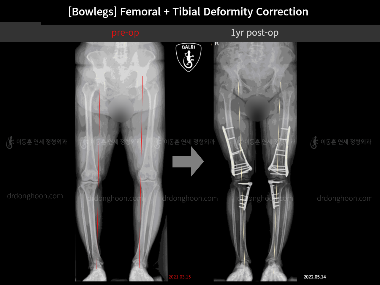 Before and after adult bowlegs, case 11512442, image 1, Dr. Donghoon institute (DALRI)