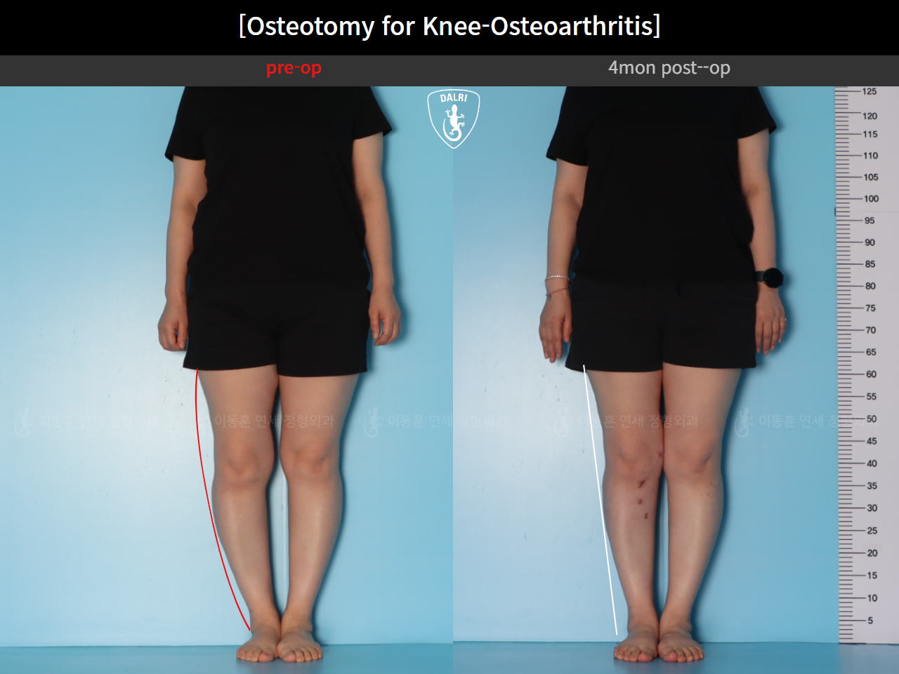Before and after osteotomy for knee osteoarthritis, case 39778471, image 1, Dr. Donghoon institute (DALRI)