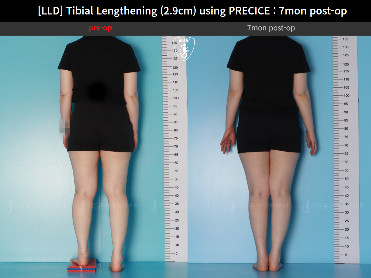 Before and after adult lld, case 62389039, image 2, Dr. Donghoon institute (DALRI)