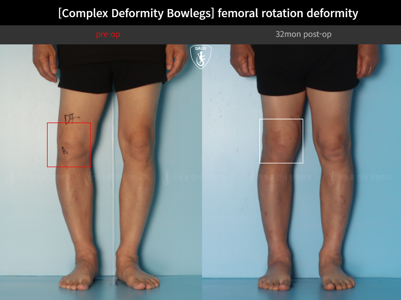 Before and after adult bowlegs, case 35242887, image 11, Dr. Donghoon institute (DALRI)