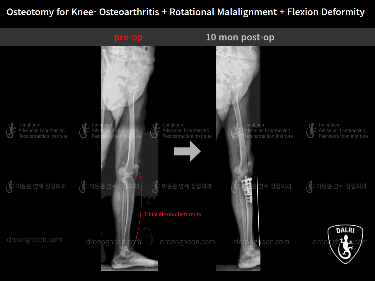 Before and after adult bowlegs, case 9128510, image 8, Dr. Donghoon institute (DALRI)