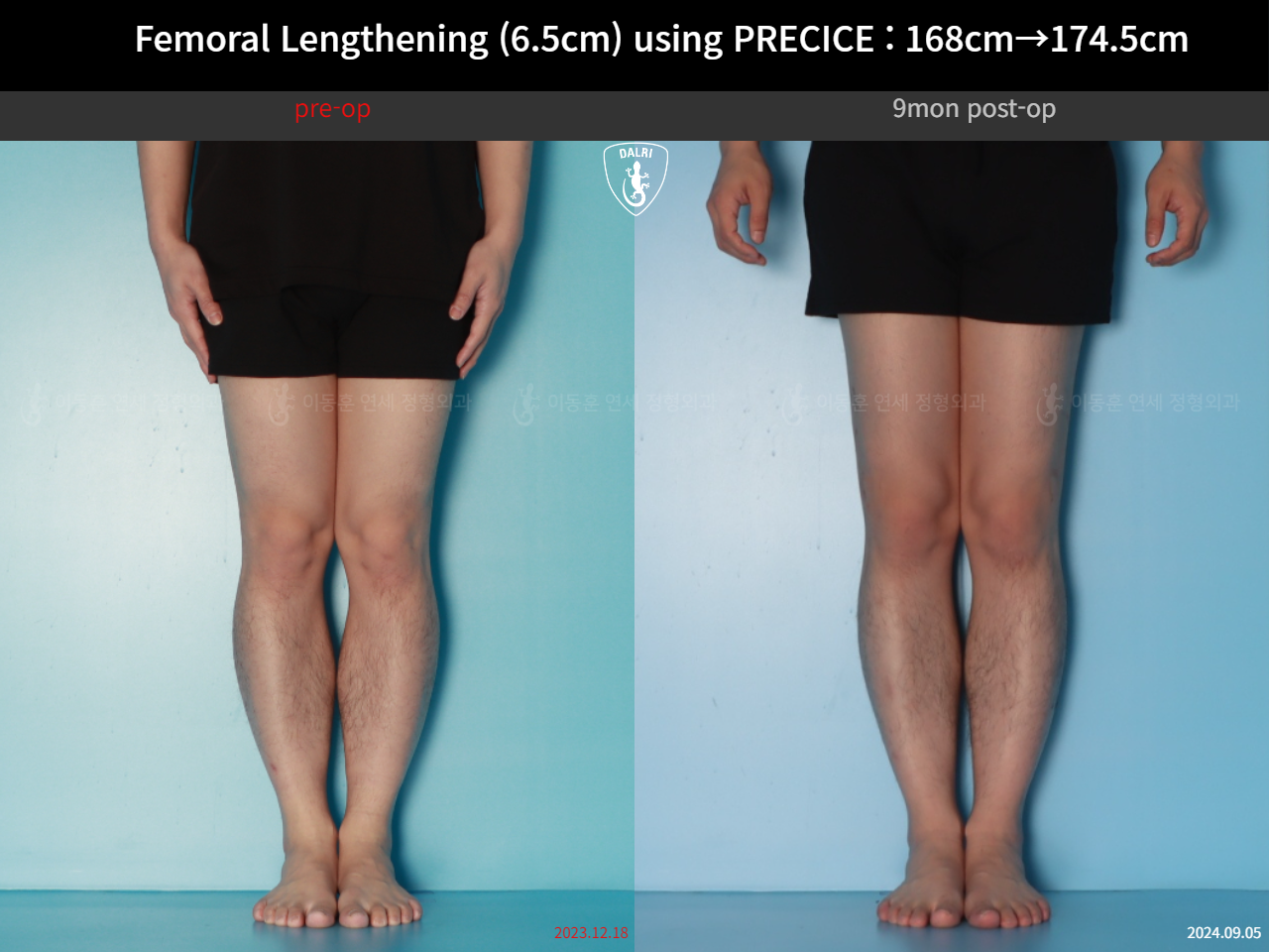 Before and after cll precice, case 123911358, image 7, Dr. Donghoon institute (DALRI)