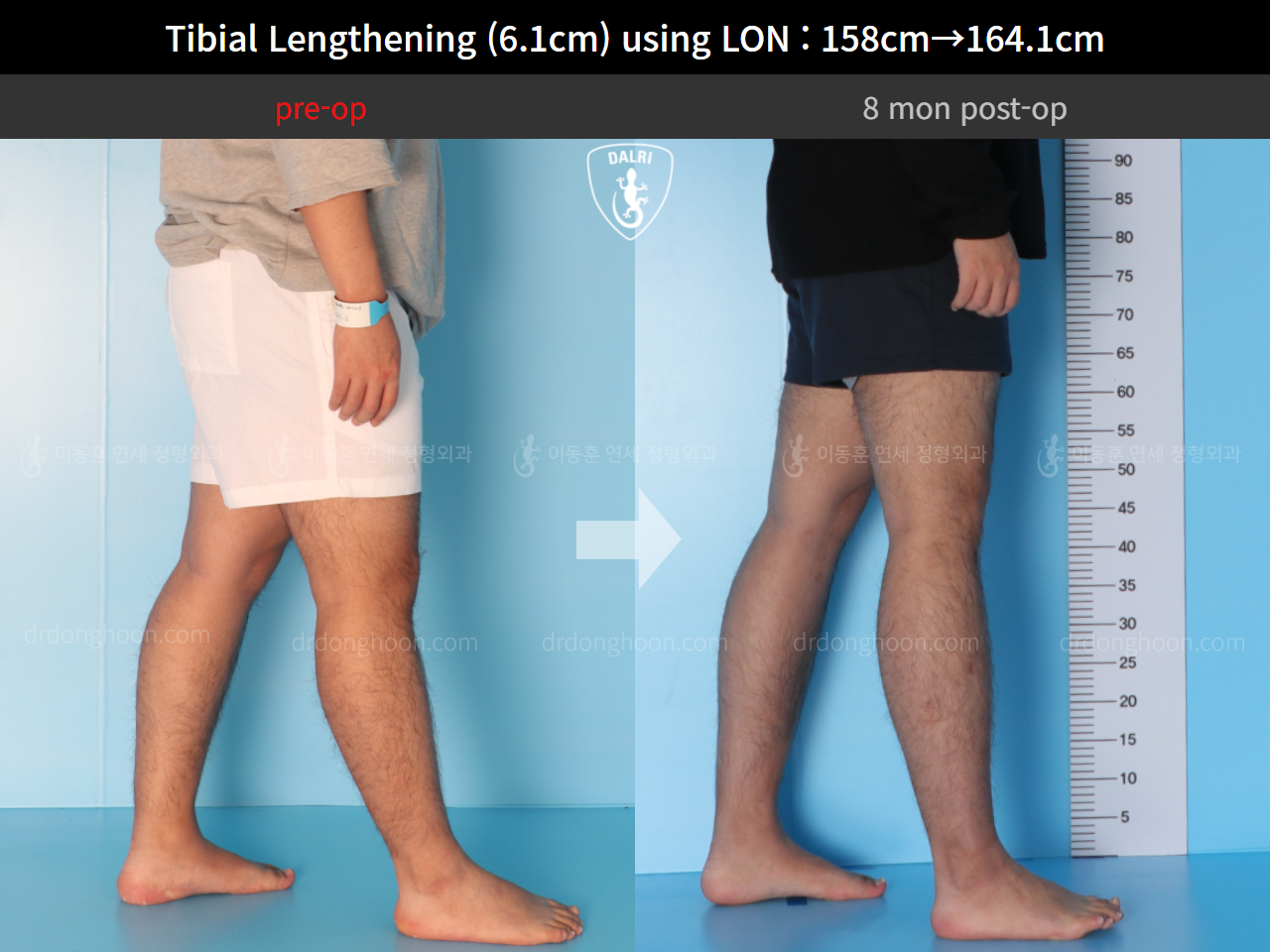 Before and after cll lon, case 4577743, image 8, Dr. Donghoon institute (DALRI)