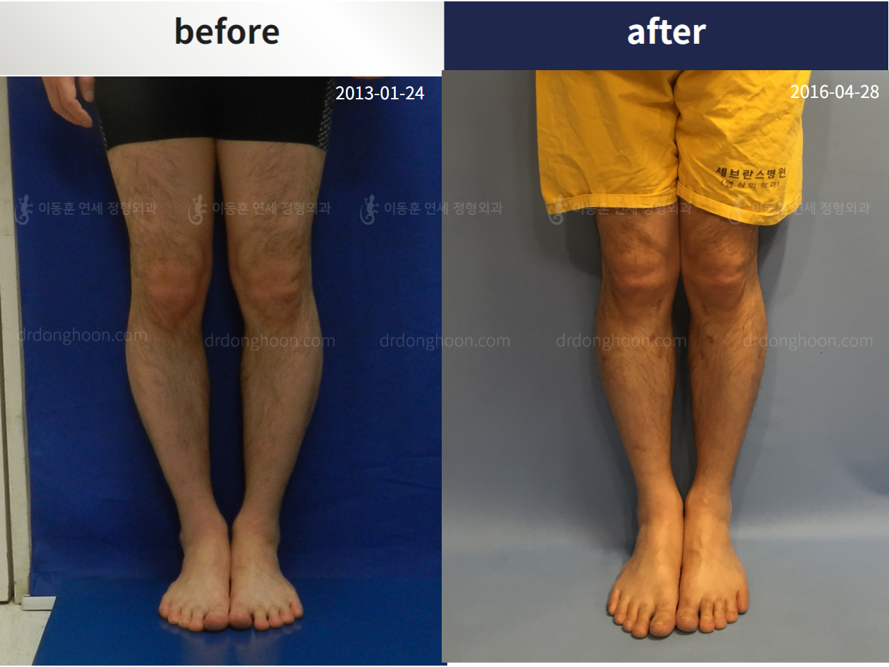 Before and after adult bowlegs, case 4311102, image 1, Dr. Donghoon institute (DALRI)