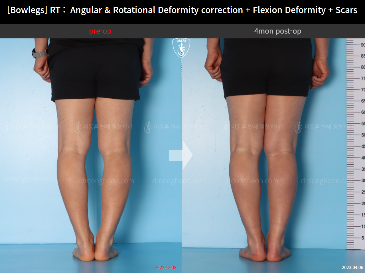 Before and after adult bowlegs, case 14701830, image 8, Dr. Donghoon institute (DALRI)