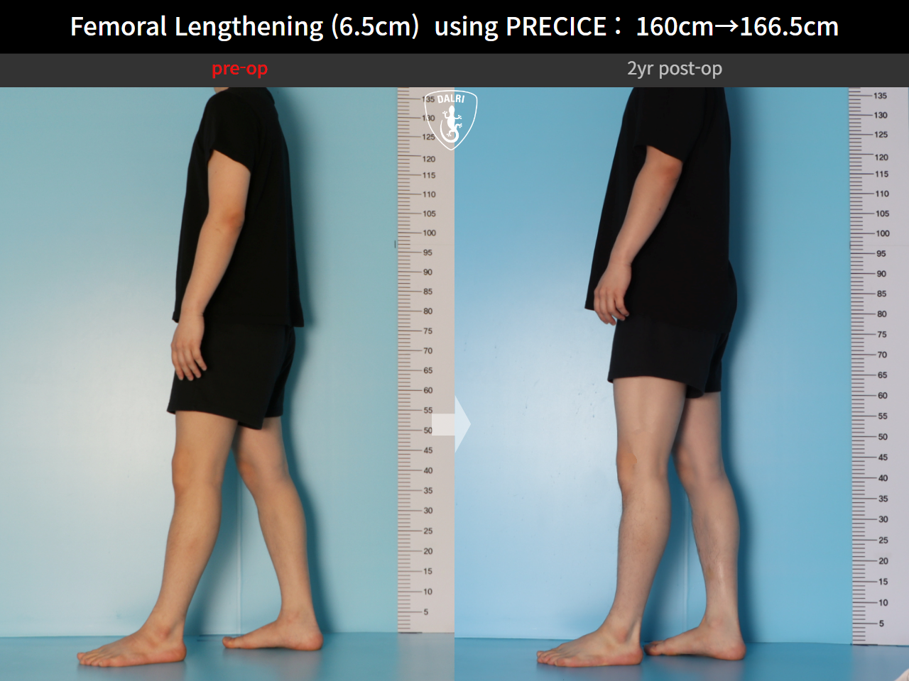 Before and after cll precice, case 27369651, image 3, Dr. Donghoon institute (DALRI)