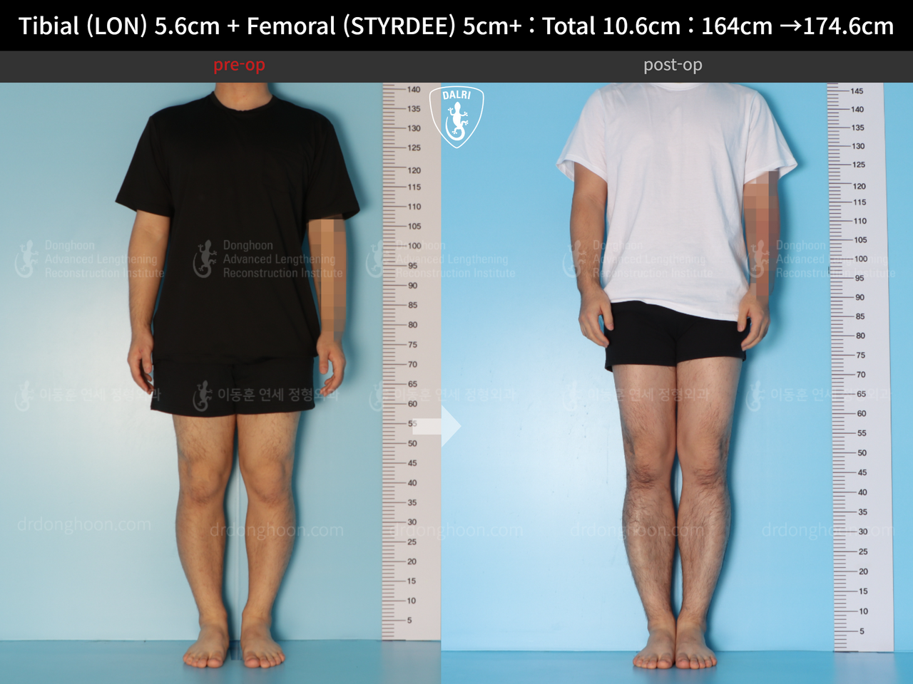 Before and after cll precice, case 13942494, image 5, Dr. Donghoon institute (DALRI)