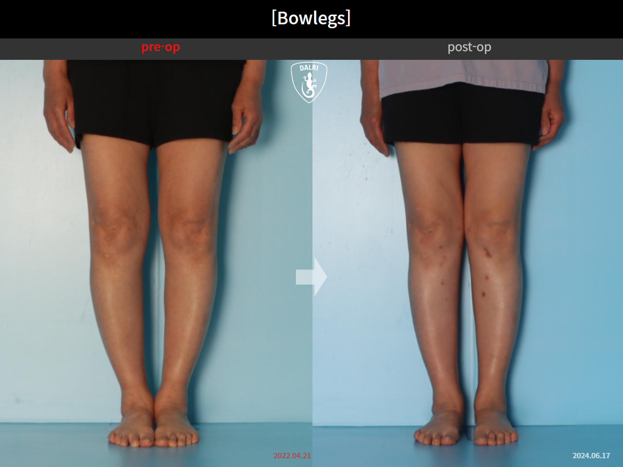 Before and after adult bowlegs, case 30770070, image 8, Dr. Donghoon institute (DALRI)