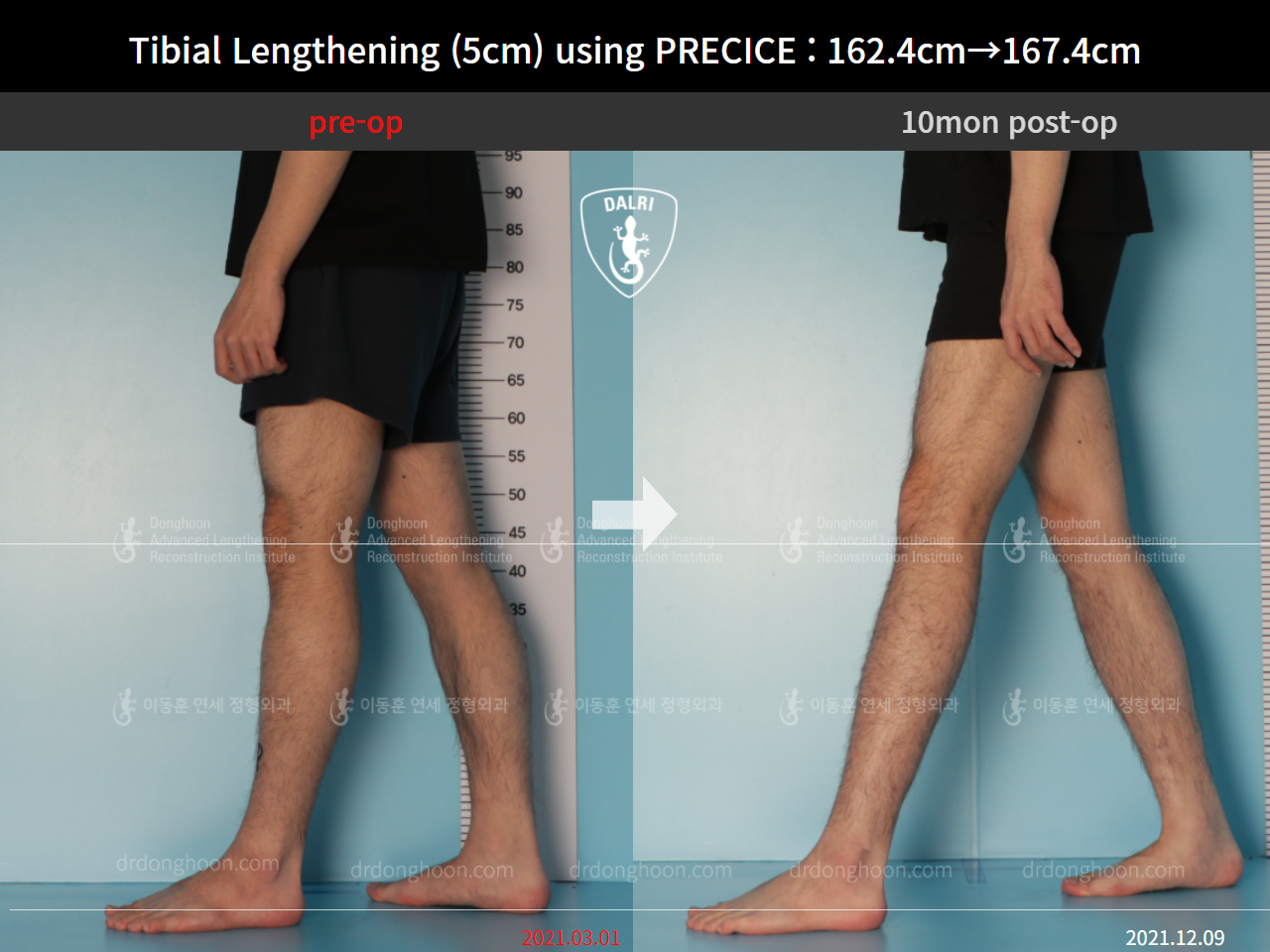 Before and after cll precice, case 9101885, image 7, Dr. Donghoon institute (DALRI)