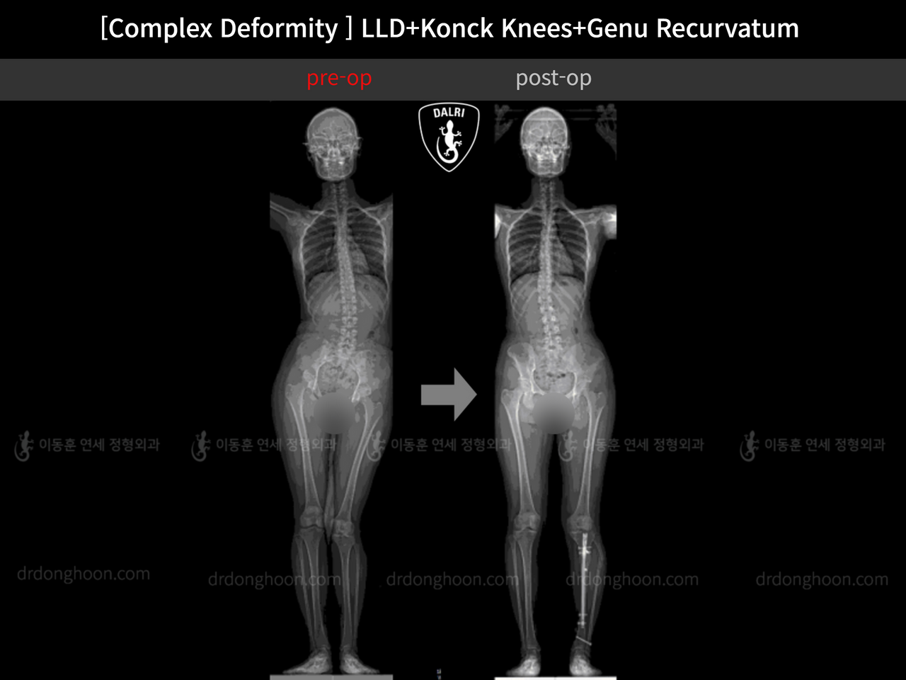 Before and after complex deformity, case 12333607, image 8, Dr. Donghoon institute (DALRI)