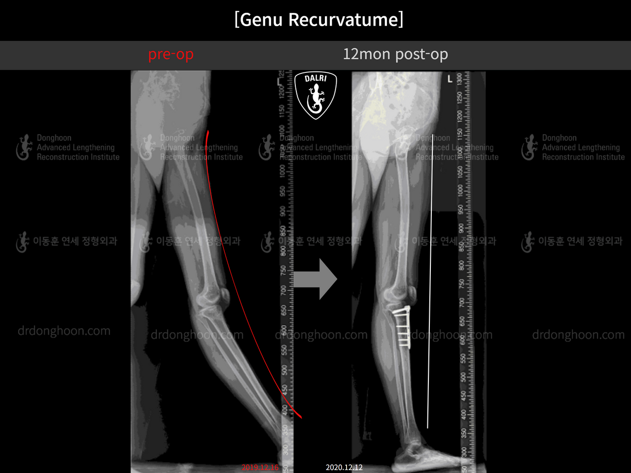 Before and after genu recurvatum, case 12484595, image 3, Dr. Donghoon institute (DALRI)