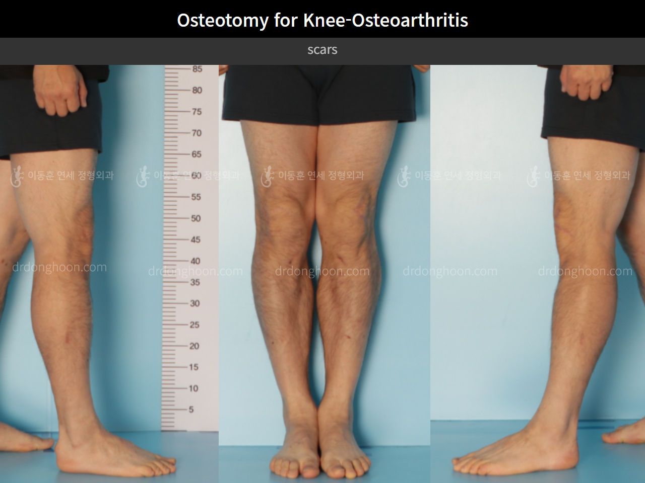 Before and after osteotomy for knee osteoarthritis, case 5394670, image 5, Dr. Donghoon institute (DALRI)