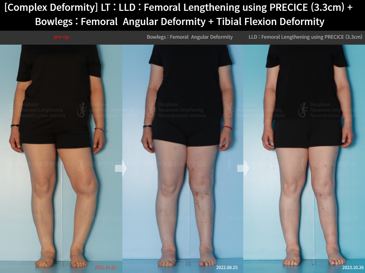 Before and after adult lld, case 16786688, image 2, Dr. Donghoon institute (DALRI)